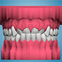Wady ortodontyczne - zgryz krzyżowy