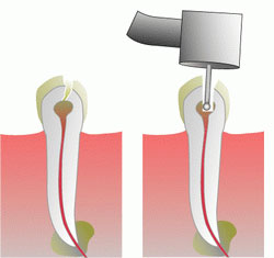 Moderne Endodonnz in Breslau