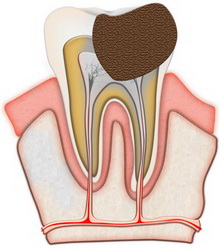 Deep caries