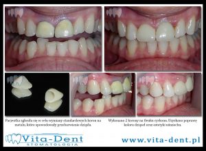 crowns on zirconium oxide