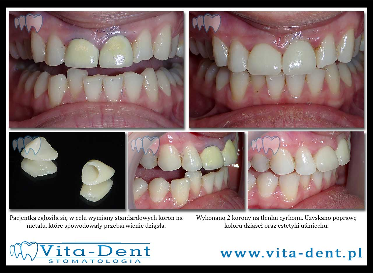 crowns on zirconium oxide