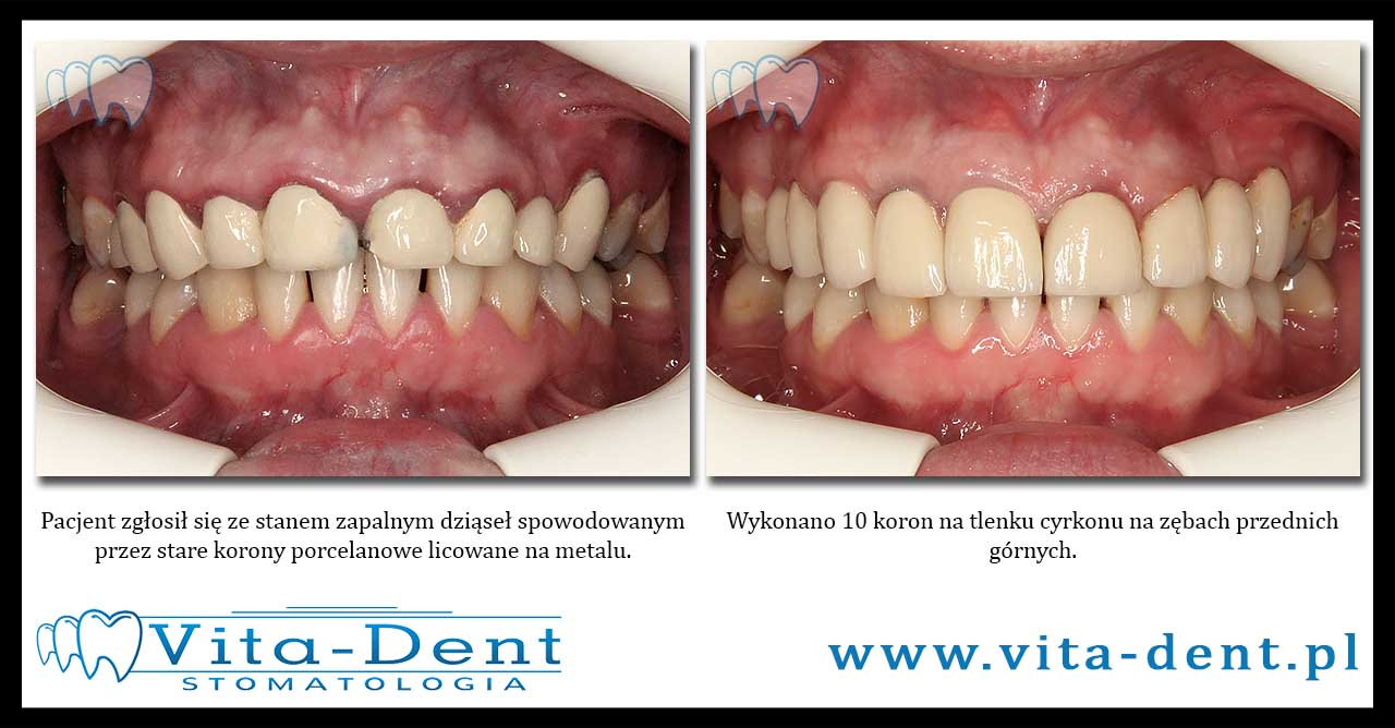 Zirconium oxide crowns Wroclaw