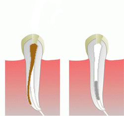 Endodontic treatment under a microscope