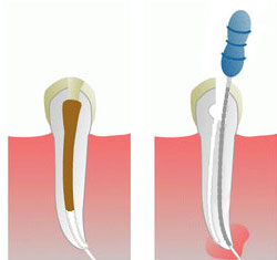 treatment under a microscope