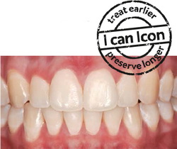 treatment of icon teeth