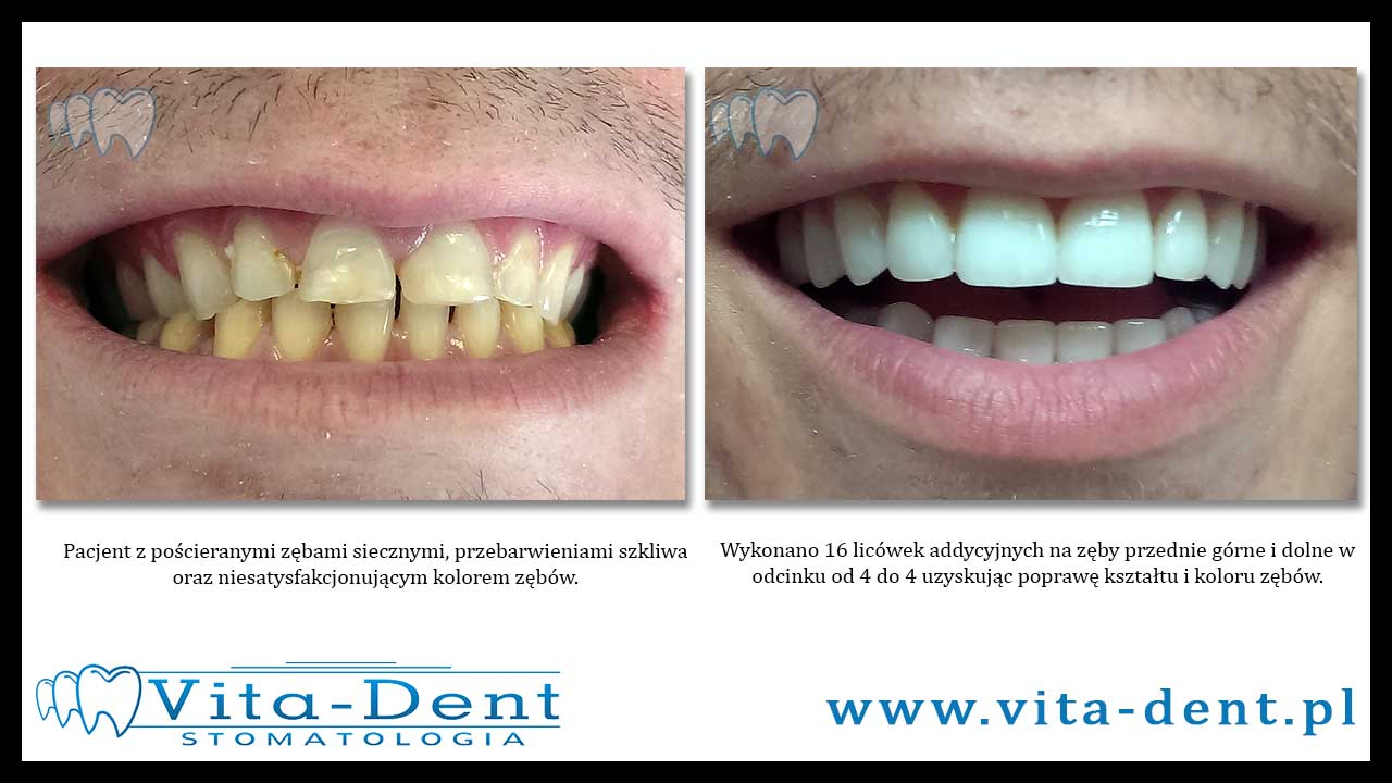 Additive veneers Wroclaw