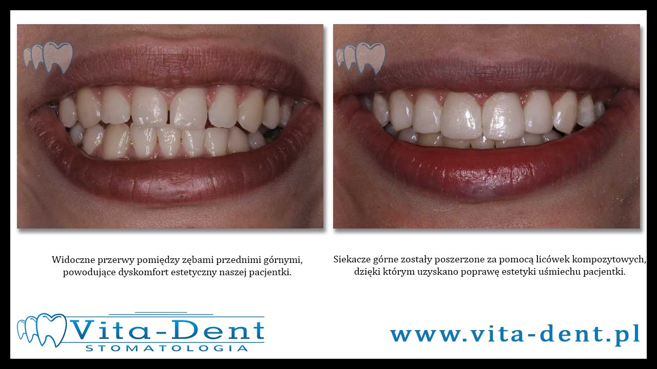 Wrocław composite veneers