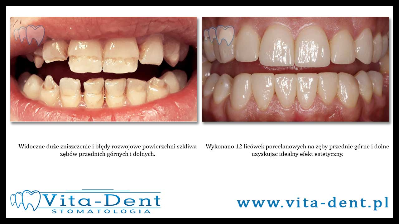 12 porcelain veneers of upper and lower teeth