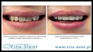 Porcelain veneers Wroclaw