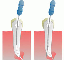 Root crown perforation