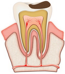 initial caries