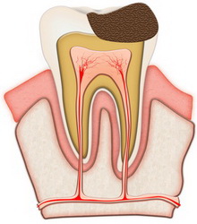 próchnica zęba