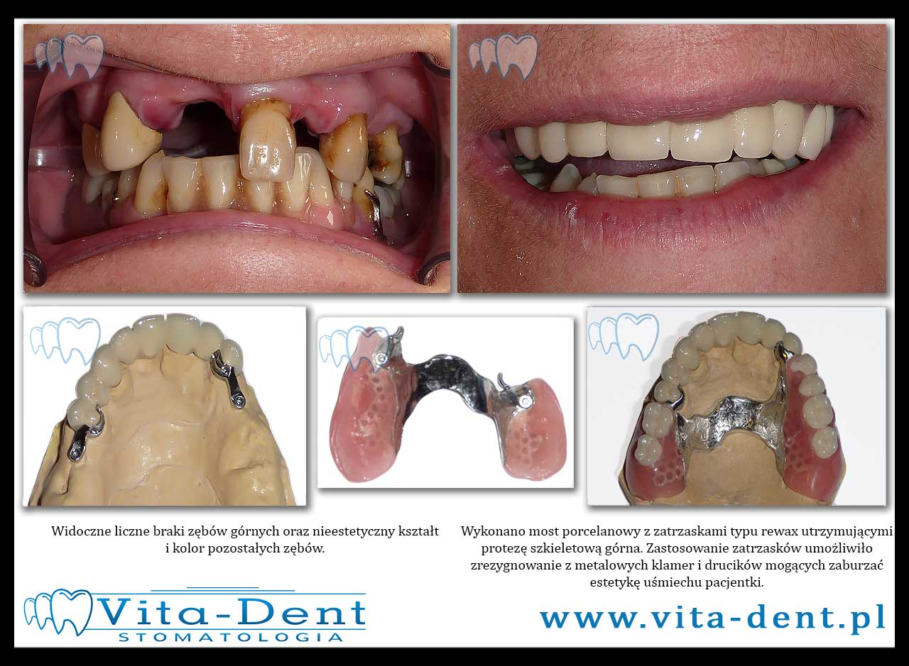 skeletal dentures with snaps Wrocław