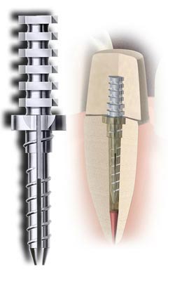 Root contribution Wroclaw - tooth reconstruction