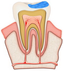 cured tooth