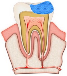 tooth filling