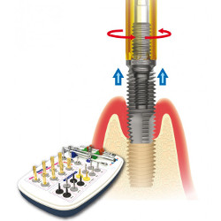 Removal of dental implants Wroclaw