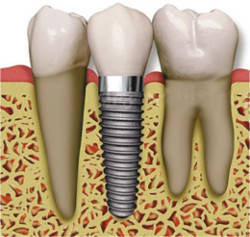 Follow-up after implanting implants