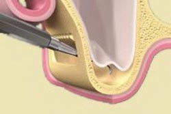 Bottom of the maxillary sinus