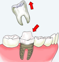 implant zeba replicate