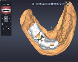 implants without scalpel