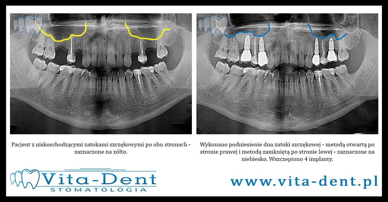 Implants maxillary sinus lift