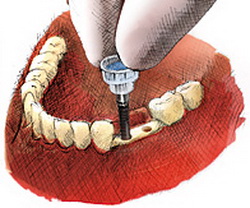 Implantate Breslau Preisliste