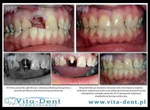 tooth crown 1 on implant
