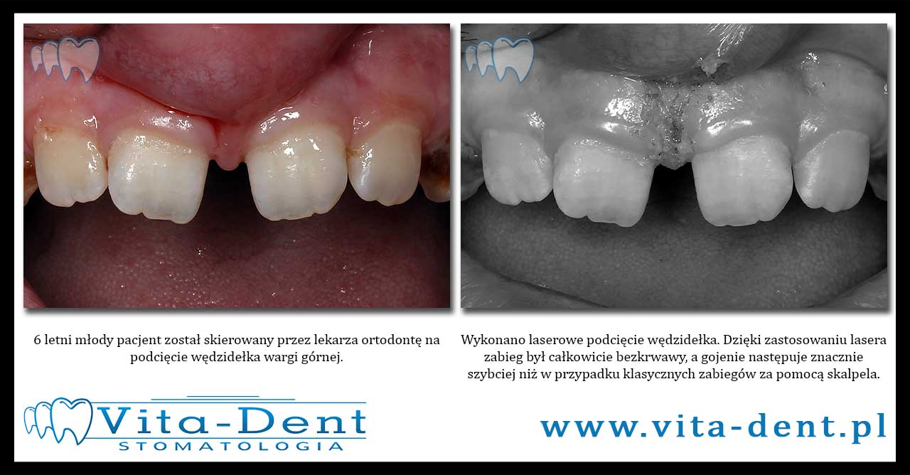 Laser Frenulum Hinterschnitt Breslau