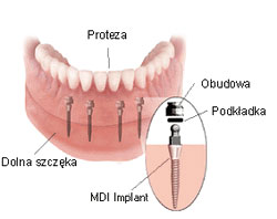 proteza na miniimplantach Wrocław