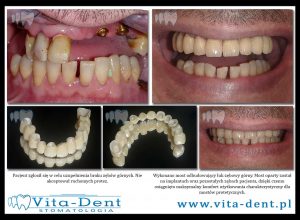 Bridge on implants - zirconia