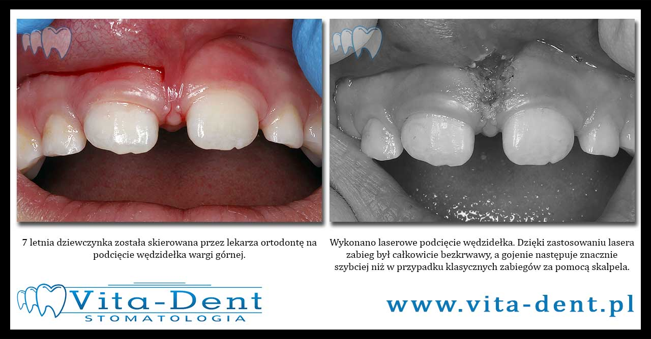 laser cutting of the frenulum Wroclaw