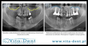 raising the bottom of the maxillary sinus Wroclaw