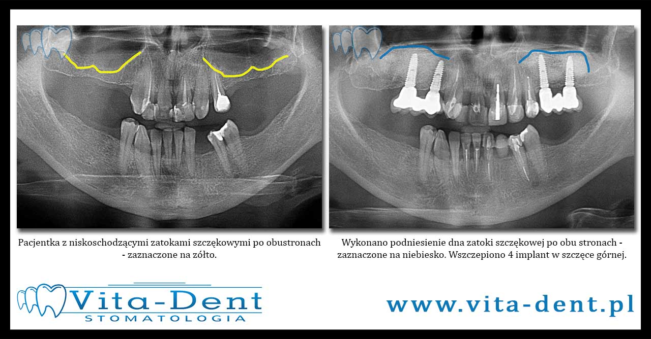 raising the bottom of the maxillary sinus Wroclaw