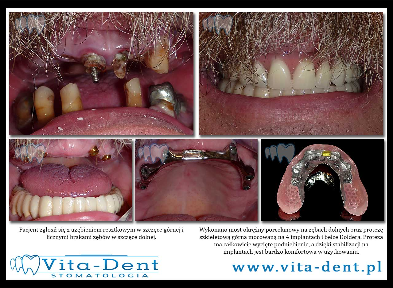 Prosthesis on implants and Dolder beam