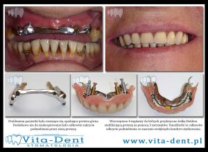 Dentures on implants wroclaw