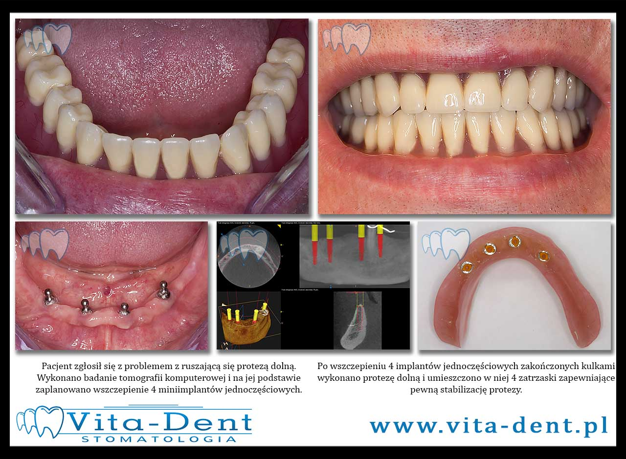 Prostheses on mini-implants Wroclaw