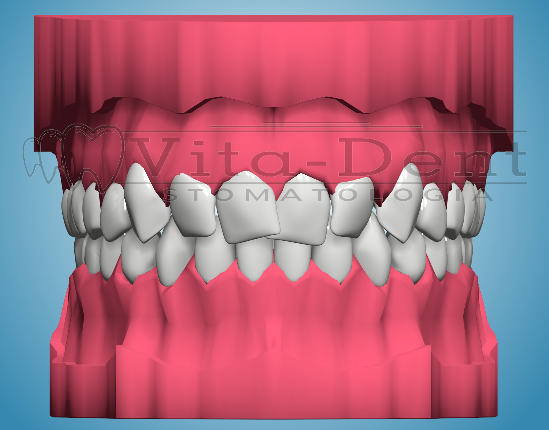 Tooth stamping - orthodontic treatment