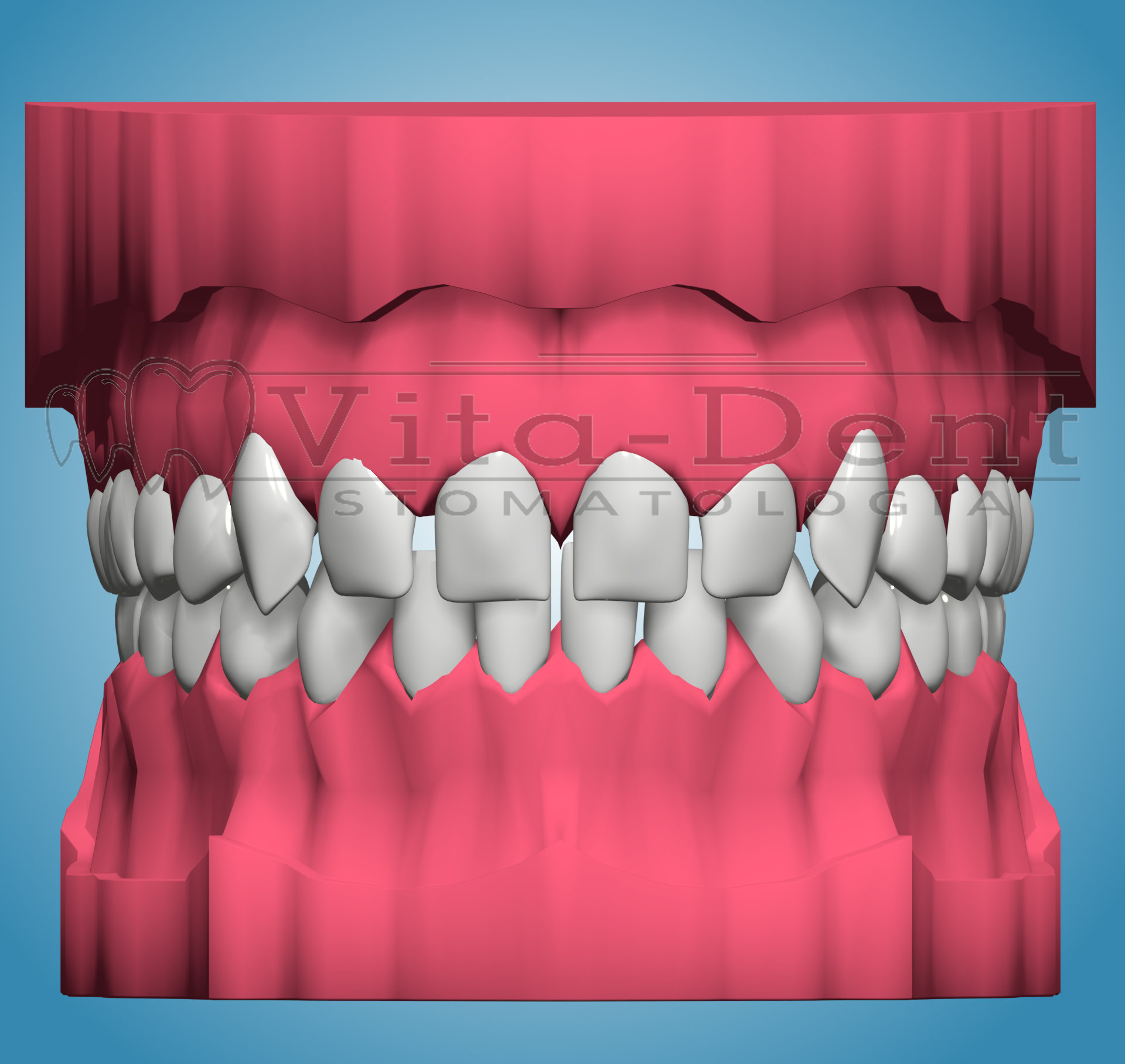 Orthodontic treatment - schaetah, spaces between teeth