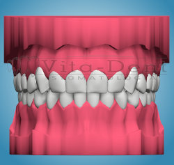 Orthodontic model - properly set teeth