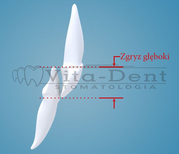 Leczenie ortodontyczne Zakrzów - nagryz pogłębiony