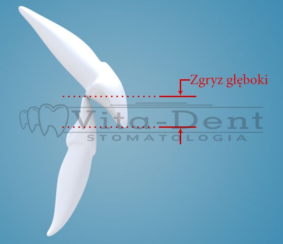 Ortodonta Zakrzów - zgryz głęboki