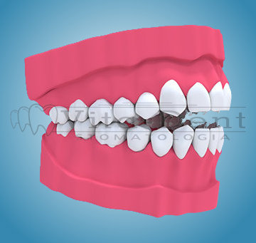 Orthodontic treatment with a fixed camera