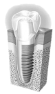 Tooth Implants Wroclaw