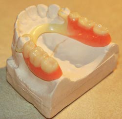 Aesthetic acetal prosthesis