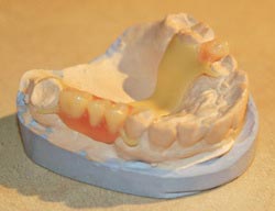 Acetal skeletal dentures