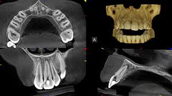 tomography of the wrocław tooth