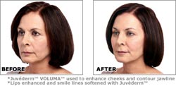 Face volume, facelift Wroclaw
