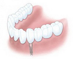 Korony na implantach