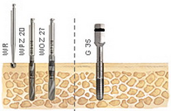 Beschreibung der Implantationsbehandlung